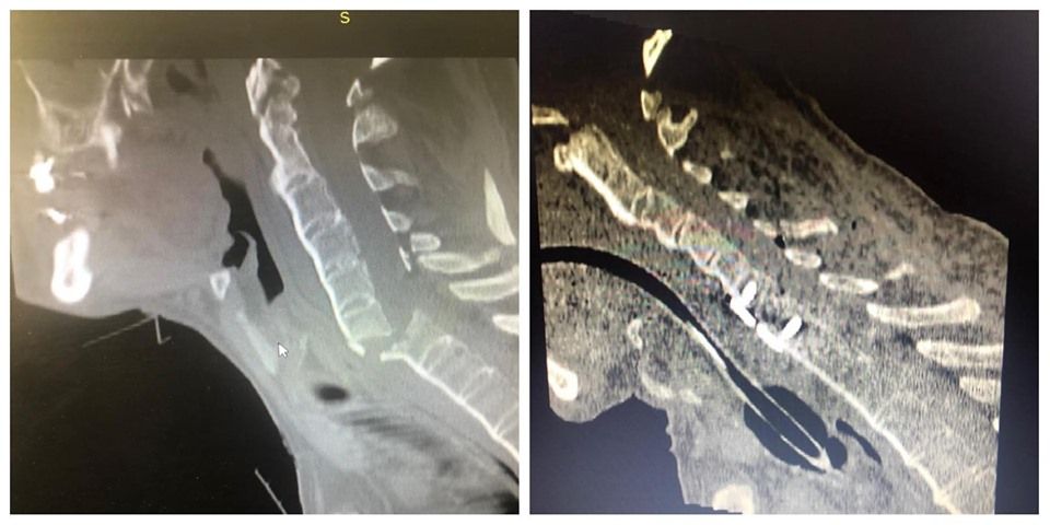 Intervenție chirurgicală complexă, care a durat 5 ore, efectuată de medicii neurochirurgi de la Spitalul Județean de Urgență Bistrița